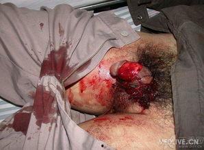 剥皮手术视频,医学奇迹与伦理挑战并存