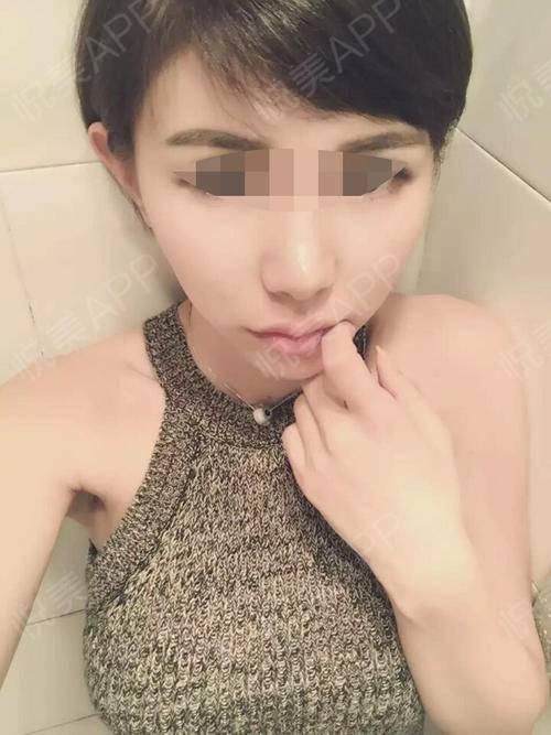 脂肪填充乳房视频,脂肪填充乳房手术全过程揭秘