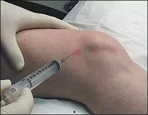 髋关节腔内注射视频,髋关节腔内注射操作步骤及要点解析