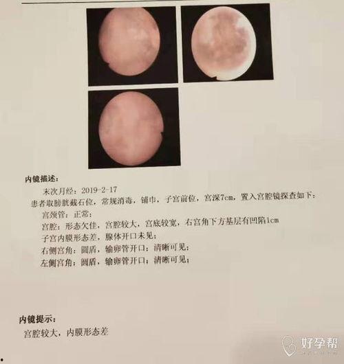 怎样做宫腔镜检查视频,宫腔镜检查操作步骤详解视频