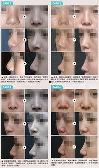 取耳软骨视频,视频详解